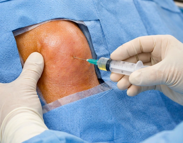 Arthrite septique, ponction exploratrice