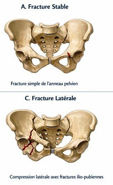 Fractures du bassin, traumatisme du bassin