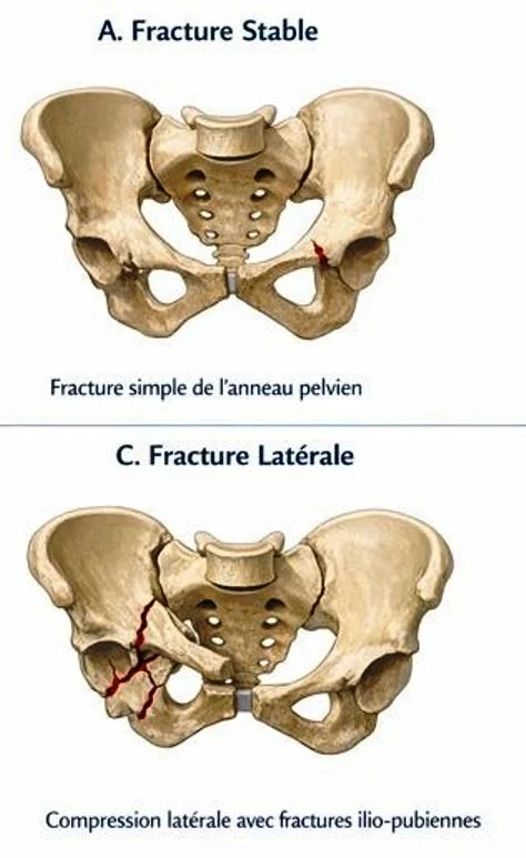 Fractures du bassin, traumatisme de la ceinture pelvienne