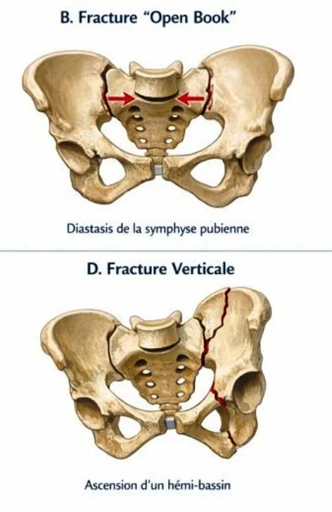 Traumatisme du bassin, fractures, diastasis
