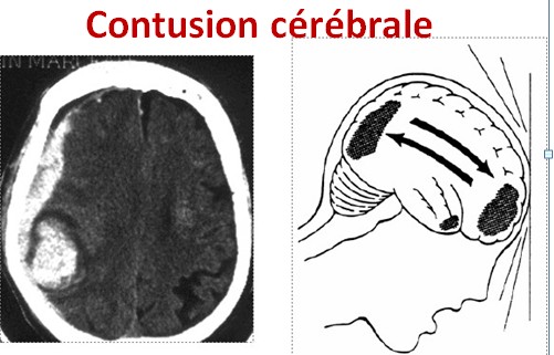 Contusion cérébrale