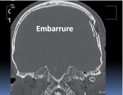 Embarrure du crâne par traumatisme crânien