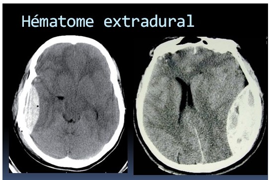 Hématome extradural traumatisme crânien
